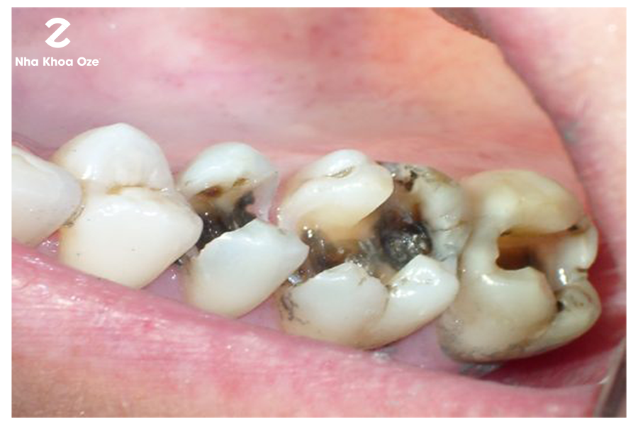Nên trị sâu răng tại nhà hay đến nha khoa?