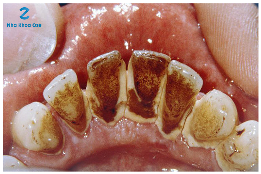 Cao răng là những mảng bám lâu ngày trên răng