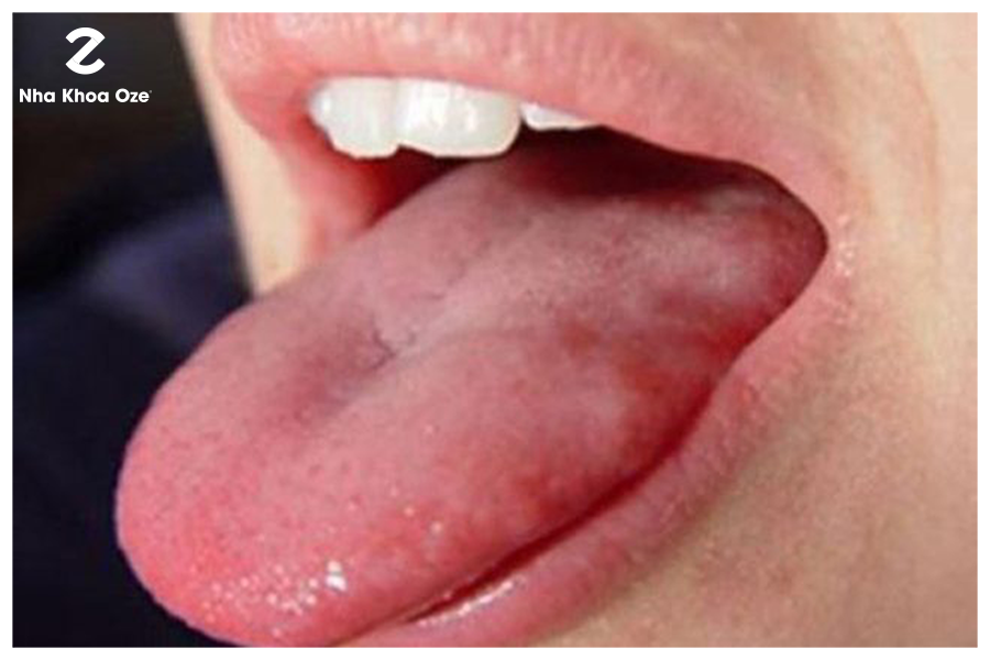 3 Trường hợp mọc mụn ở lưỡi và cách phòng tránh hiệu quả