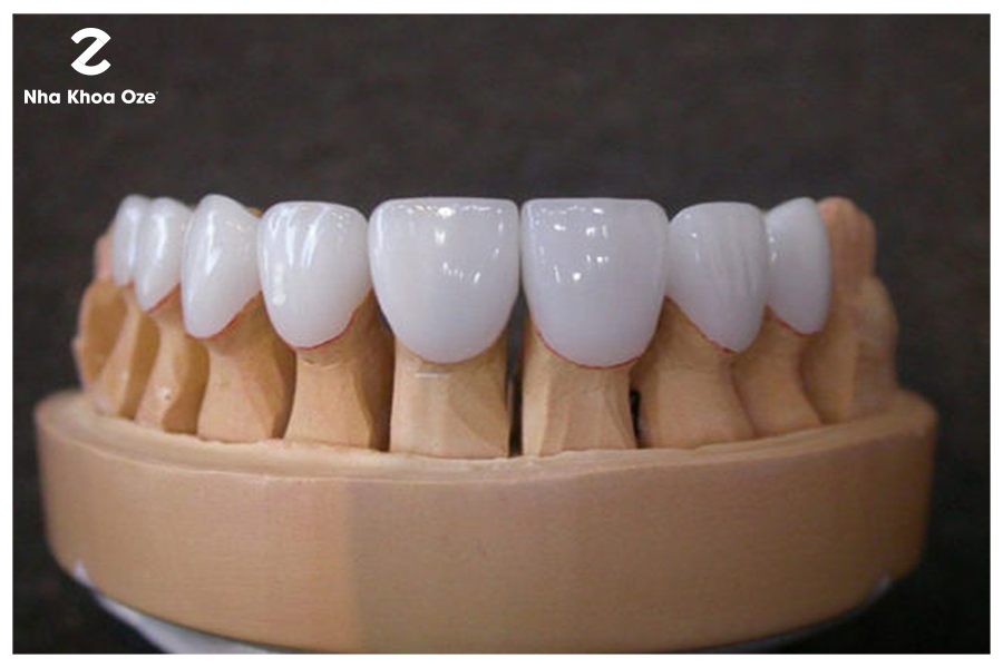 Răng sứ titan có giá thành rẻ nhưng chất lượng ổn định