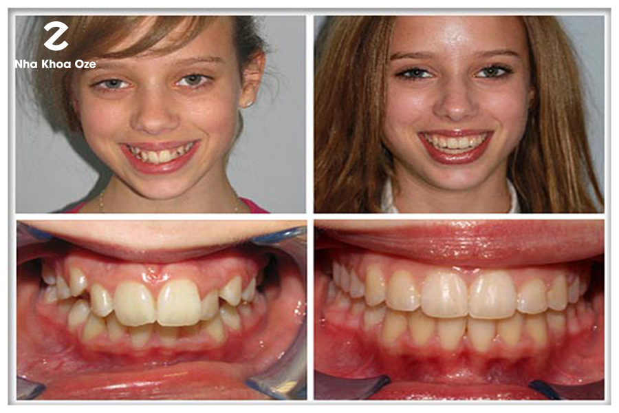 Trường hợp răng quá to, răng chèn lên, mọc xô lệch, gây răng vẩuTrường hợp răng quá to, răng chèn lên, mọc xô lệch, gây răng vẩu