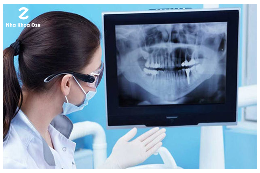 Hình ảnh x- quang răng cho biết rõ tình trạng của bạn