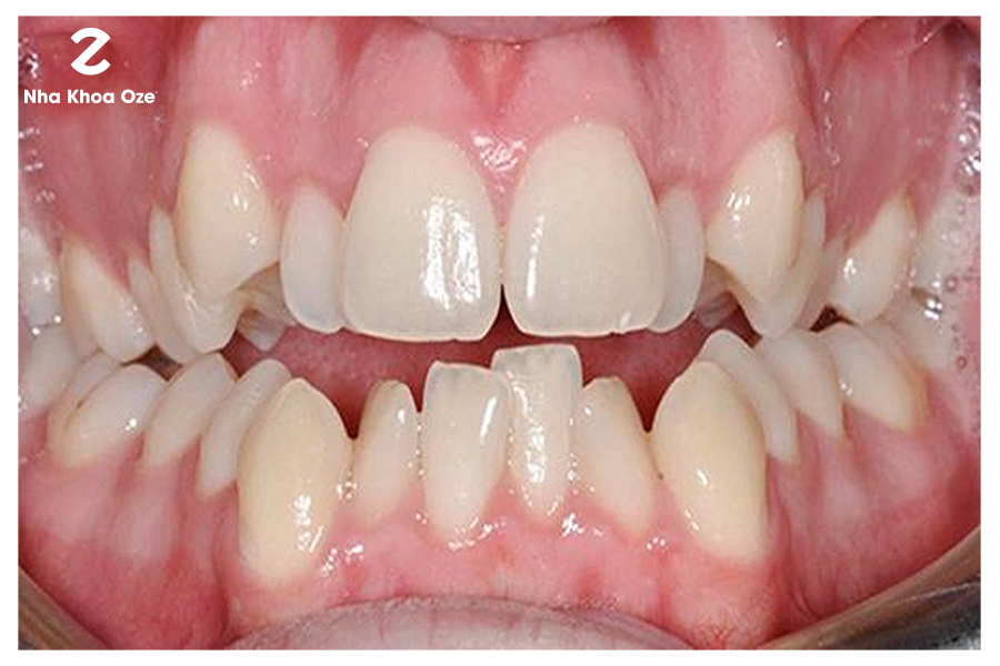 Răng xấu - Nguyên nhân và 4 cách khắc phục hiệu quả