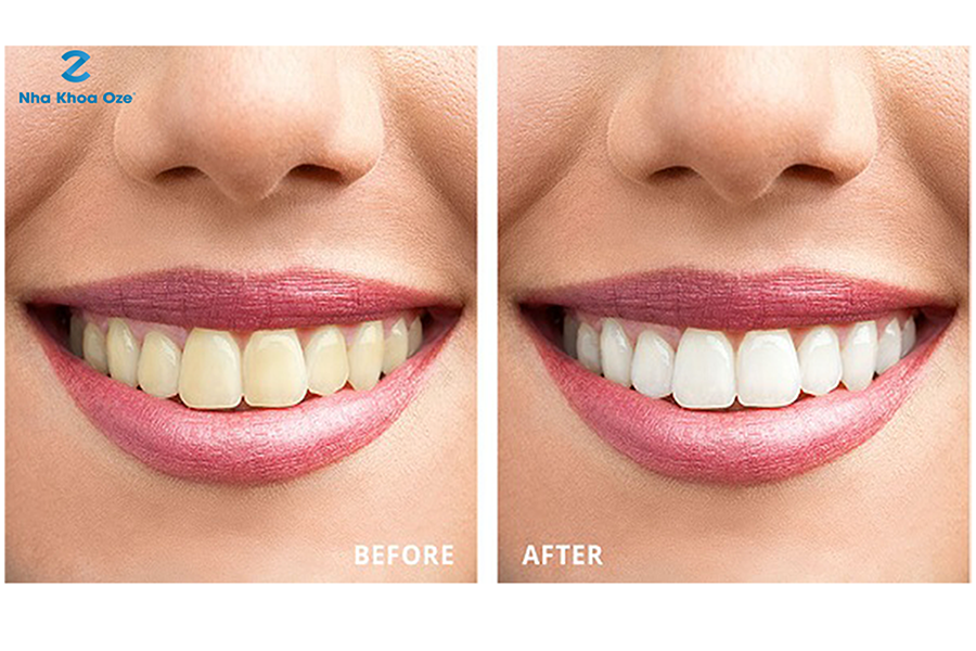 Dặn dò bệnh nhân các lưu ý sau khi tẩy trắng răng laser whitening