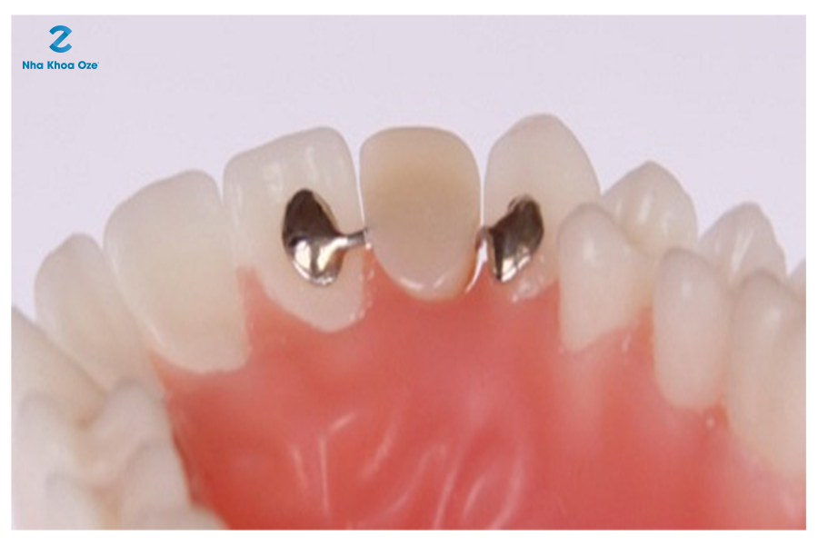 Cầu răng sứ có cánh dán được dùng với vùng răng trước