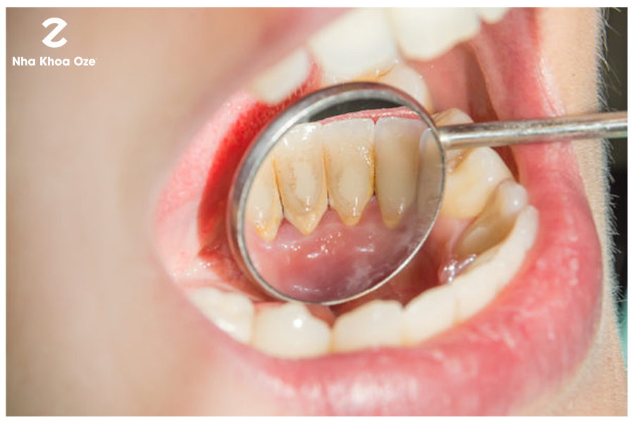 Cao răng gây ra rất nhiều bệnh lý nha khoa nghiêm trọng