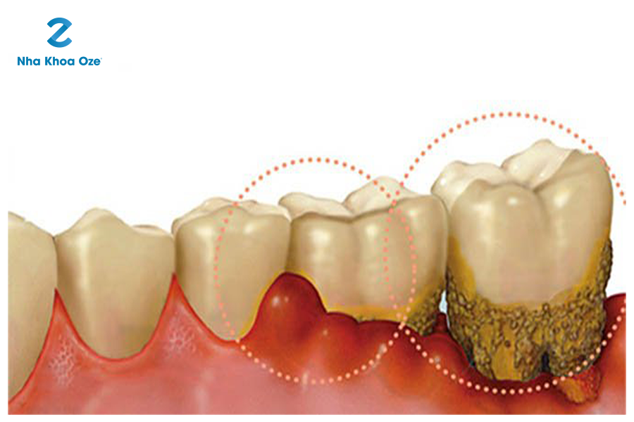 Các mảng bám trên răng tích tụ trong thời gian dài gây viêm chân răng