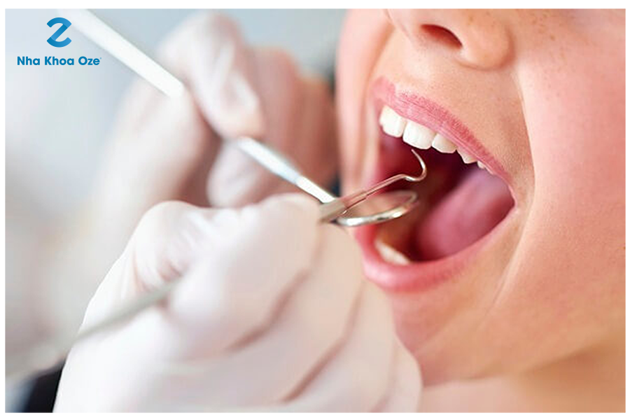Viêm quanh răng xảy ra do sai sót trong quá trình chữa viêm tủy