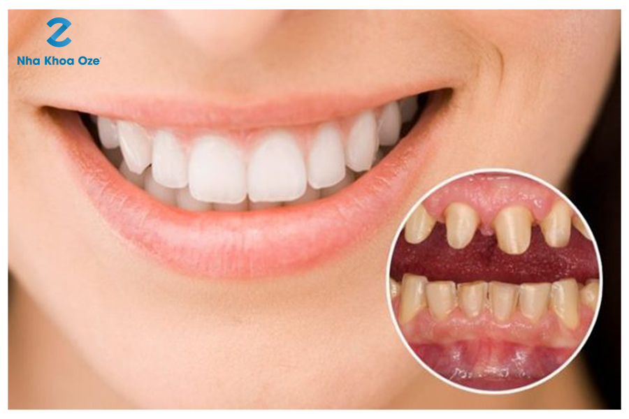 Bọc răng sứ là giải pháp thích hợp cho những người bị thưa răng cửa và đem lại tính thẩm mỹ rất cao