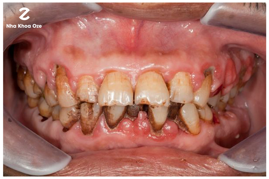 Chân răng bị đen dẫn đến một số bệnh lý về răng nguy hiểm