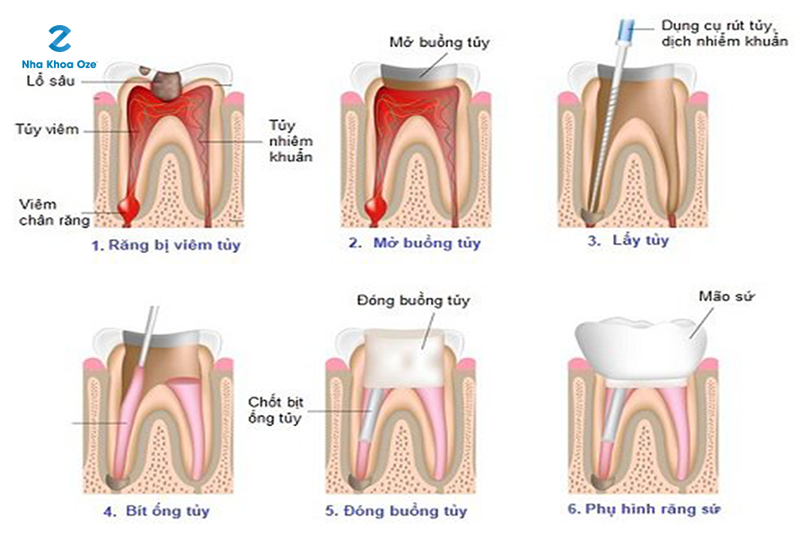 Hình ảnh các bước rút tủy răng