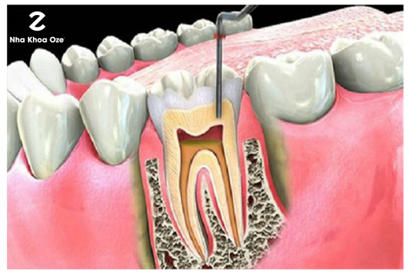 Hình ảnh cắt khi răng bị viêm tủy răng
