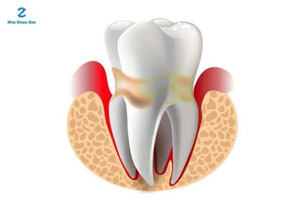 Mảng bám, cao răng (vôi răng) tạo điều kiện cho vi khuẩn trú ẩn