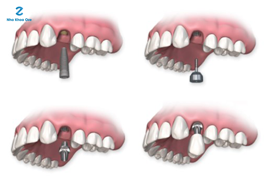 Cấy ghép răng bằng phương pháp Implant
