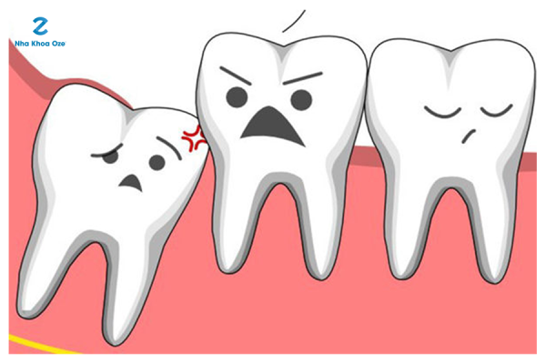 Răng khôn mọc lệch gây ảnh hưởng đến các răng bên cạnh