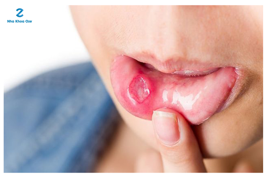 10 Cách điều trị lở miệng tại nhà đơn giản và hiệu quả