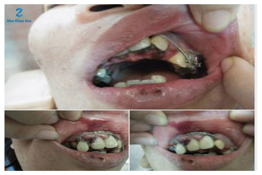 Tác hại của việc niềng răng không đúng quy trình