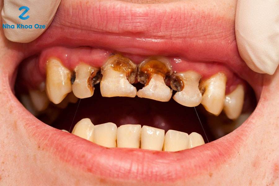 Răng sữa lung lay do bị sâu và các bệnh lý răng miệng khác