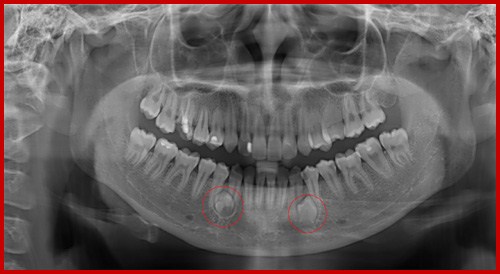 Hình ảnh chụp X-quang răng nanh mọc ngầm