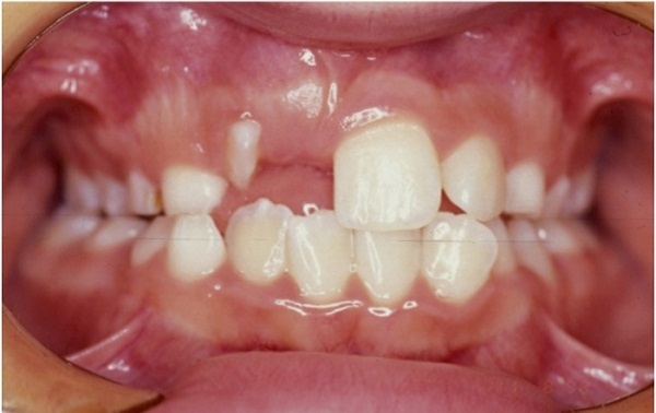 Nhổ răng nanh ngầm không gây nguy hiểm