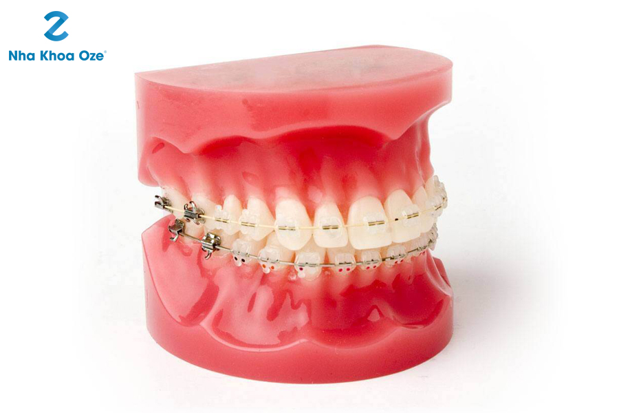 Niềng răng chỉnh nha là gì?