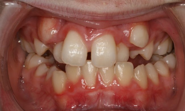 Răng nanh mọc ngầm trong xương hàm