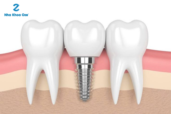 Một số khuyết điểm của trồng răng implant