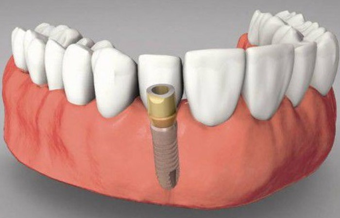 trồng răng implant bao lâu thì lành