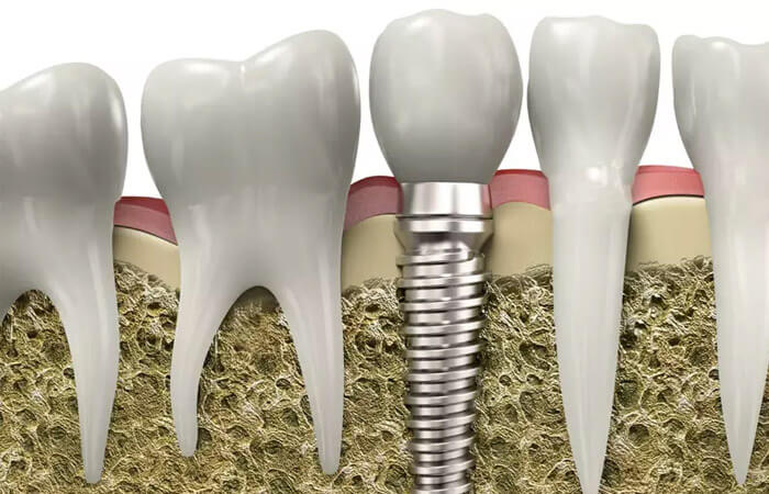 Trụ răng implant dentium mỹ