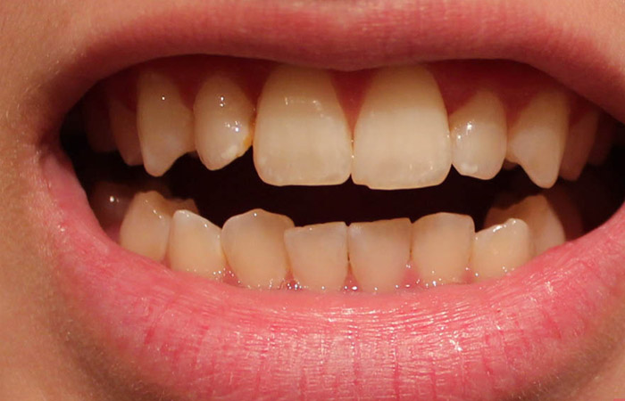  Răng vàng bẩm sinh 