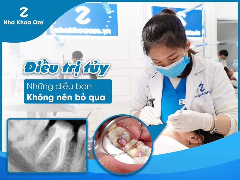 Điều trị tủy răng tại nha khoa OZE