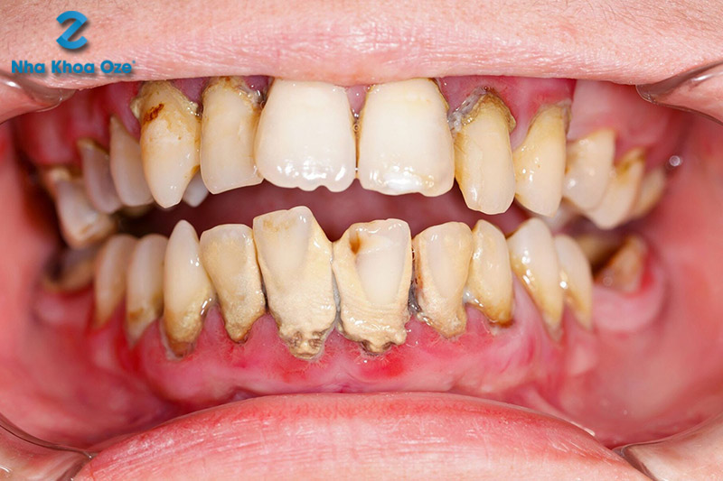 Cao răng độ 3 gây các bệnh lý răng miệng
