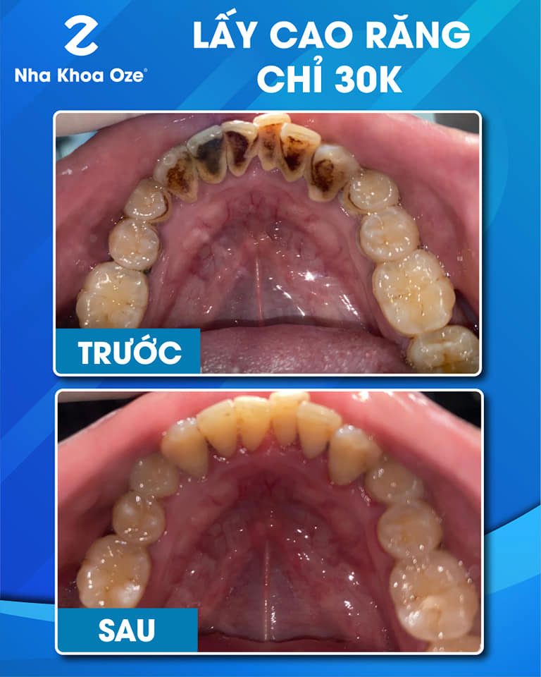 Lấy cao răng tại OZE nhanh chóng mà chỉ hết 30k