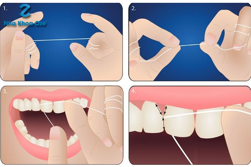 Sử dụng chỉ nha khoa để làm sạch mảng bám ở kẽ răng 