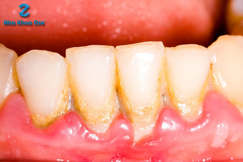 Cao răng tích tụ nhiều và lan sâu xuống vùng lợi dưới chân răng