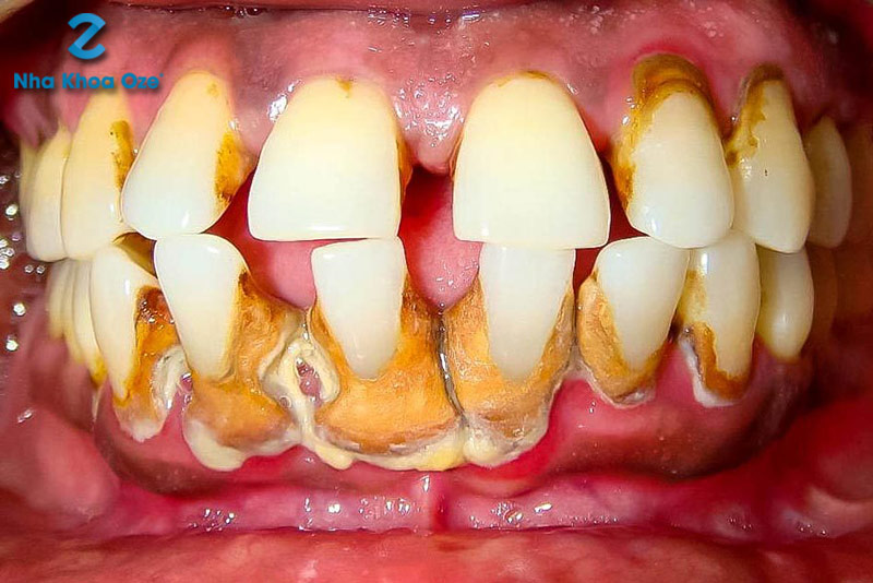 Cao răng bám ở ở mặt trong và mặt ngoài của răng gây mất thẩm mỹ đồng thời cũng ảnh hưởng đến sức khỏe răng miệng