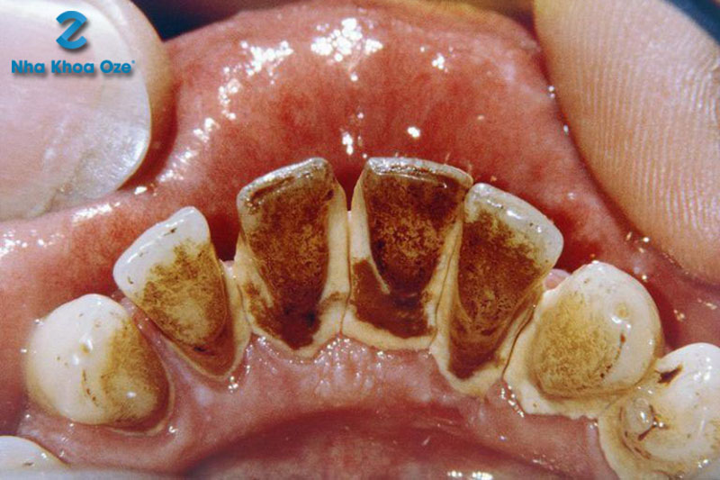 Cao răng huyết thanh bị cặn lóng bởi các dịch tiết và máu nên có màu đỏ sẫm - nâu đỏ đặc trưng