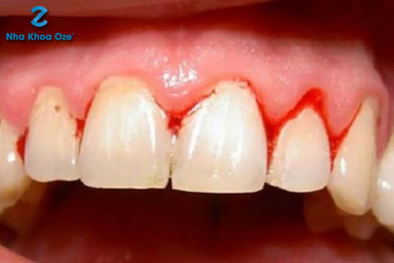 Tình trạng chảy máu chân răng thường xuyên xảy ra khi đánh răng 
