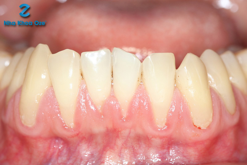 Tụt lợi làm lộ sâu chân răng, nặng hơn có thể ảnh hưởng đến khả năng nâng đỡ răng của các mô nướu kế cạnh