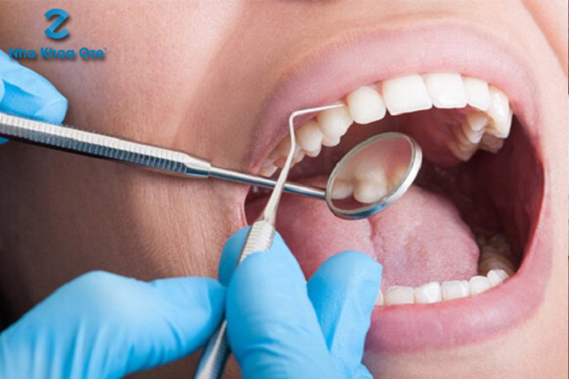 Cao răng/vôi răng bị vỡ vì đâu? Có nguy hiểm không?