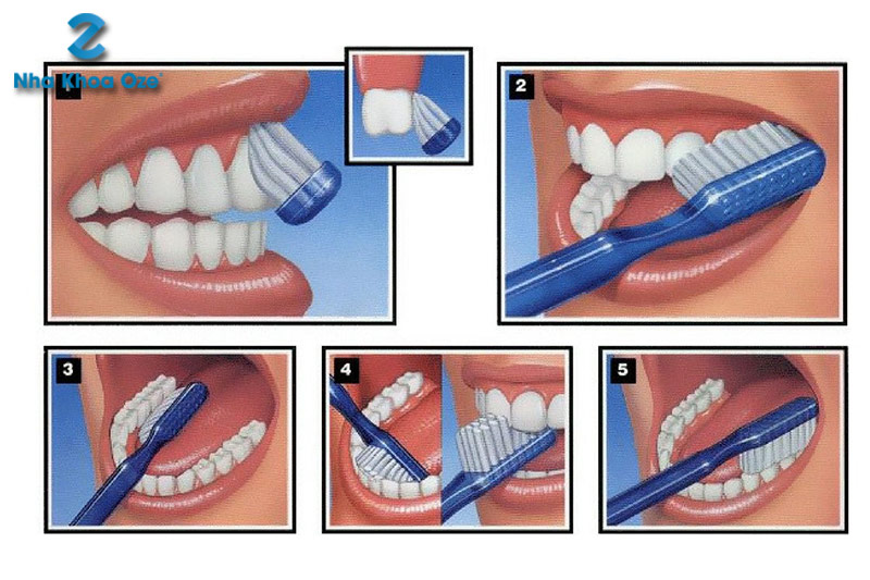Chải răng đúng cách ngừa cao răng cấp độ 3