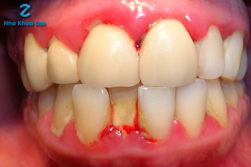 Chân răng bị chảy máu khiến khoang miệng luôn có mùi tanh hôi khó chịu 