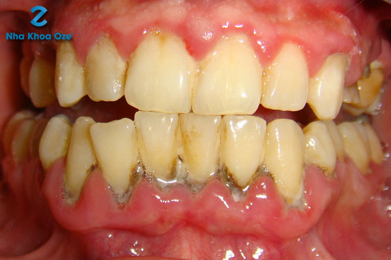 Hàm răng bị viêm nha chu do cao răng độ 3