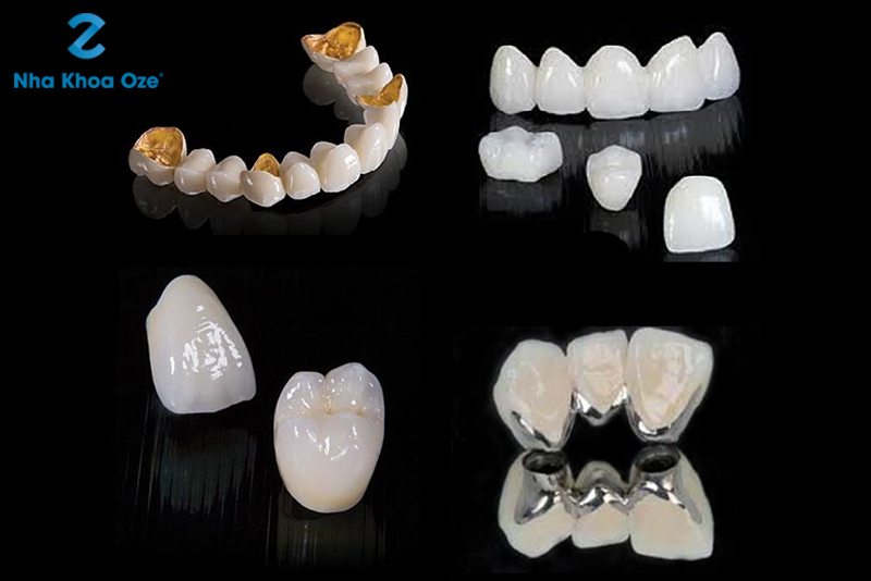Một số loại răng sứ được phổ biến trên thị trường hiện nay 
