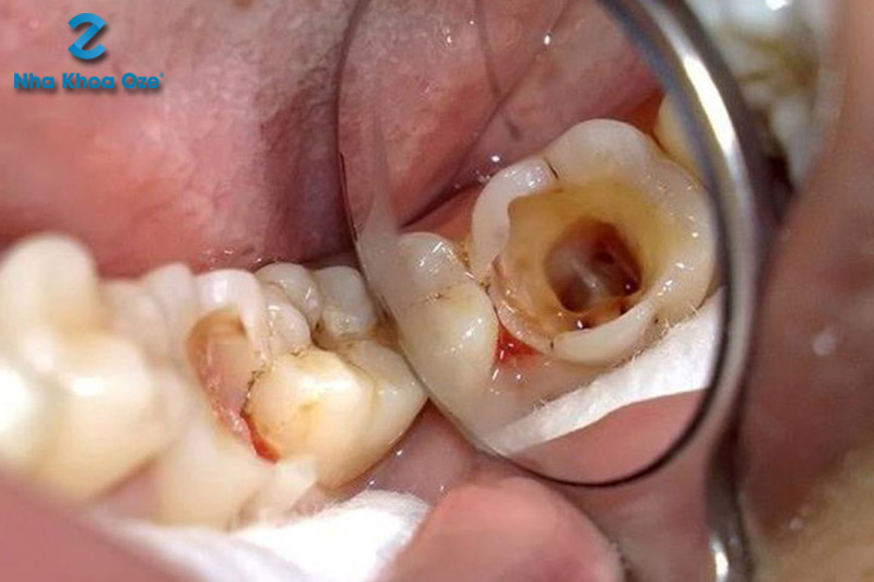 Trường hợp răng sâu to, vỡ lớn thông vào buồng tuỷ, hở tủy, cần phải lấy tủy răng