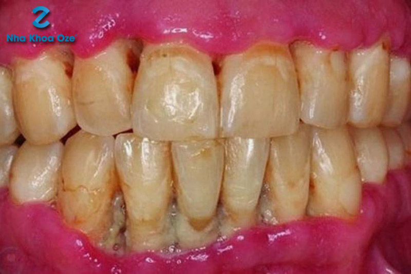 Phần nướu bị sưng đỏ, khi bị tác động bởi bàn chải đánh răng có thể bị chảy máu