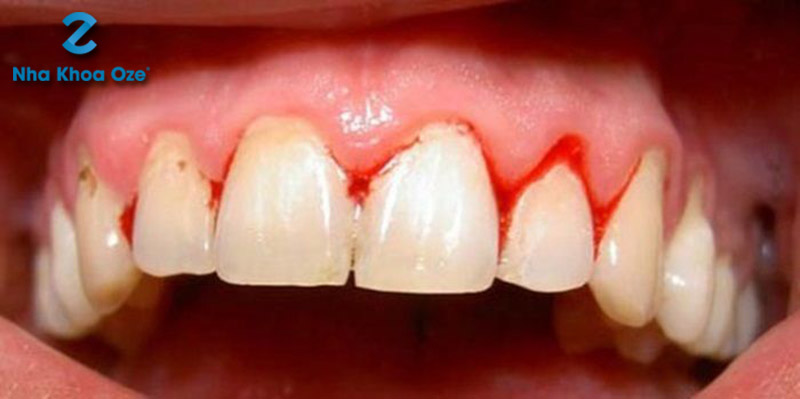 Chảy máu chân răng khi lấy cao răng