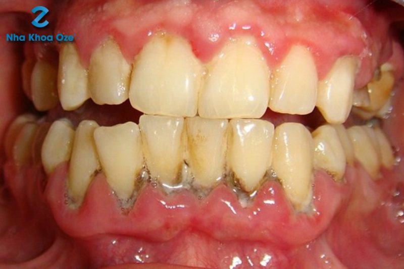 Cao răng bám dày đặc gây tụt lợi