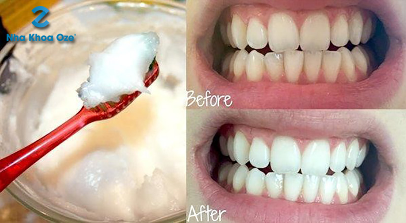 Đánh răng bằng Baking Soda để sạch cao răng