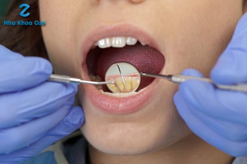 Lấy cao răng bằng các dụng cụ được tiệt trùng